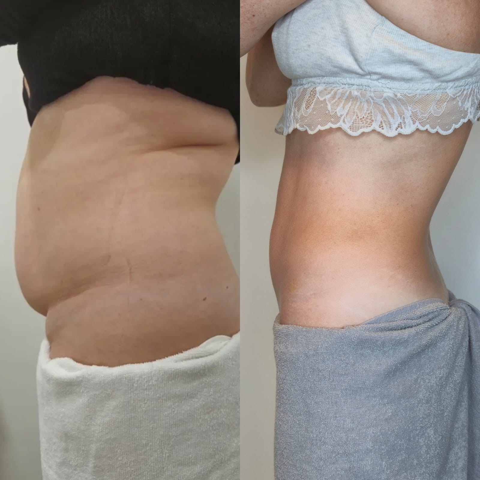 Resultado real de HIFU Corporal antes e depois