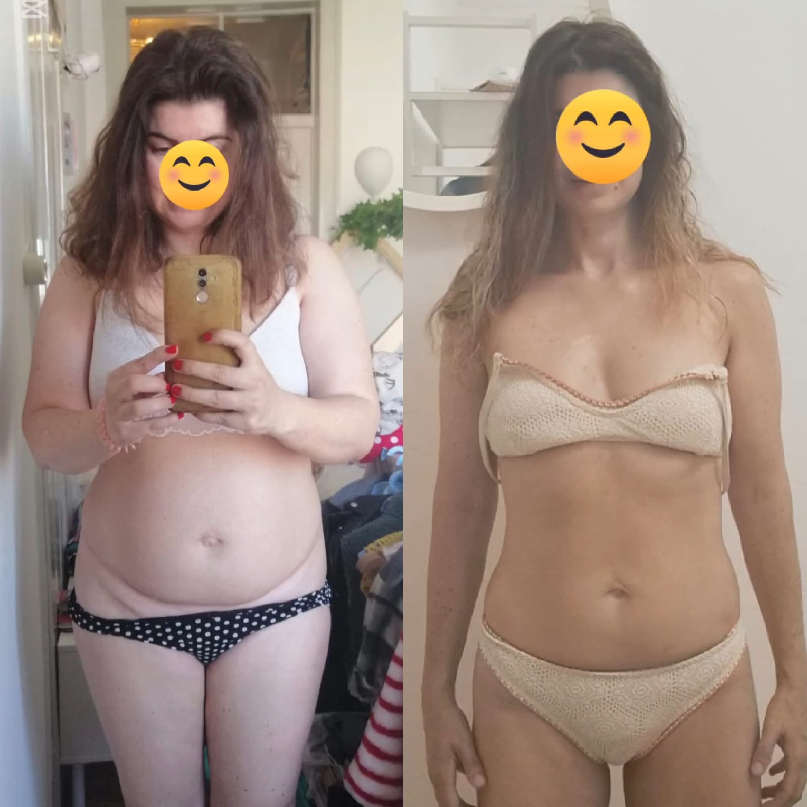 Resultado real de HIFU Corporal antes e depois