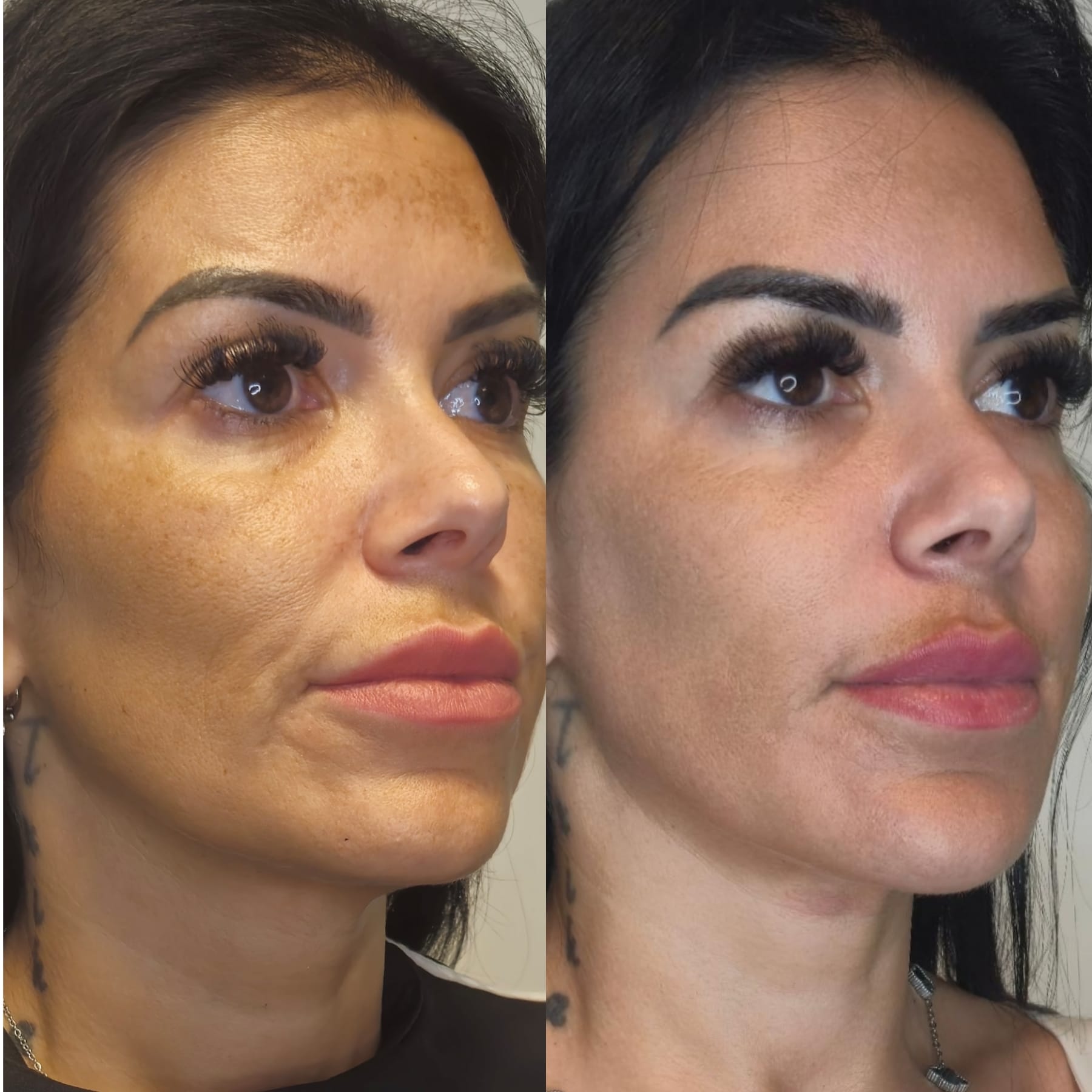 Resultado HIFU facial