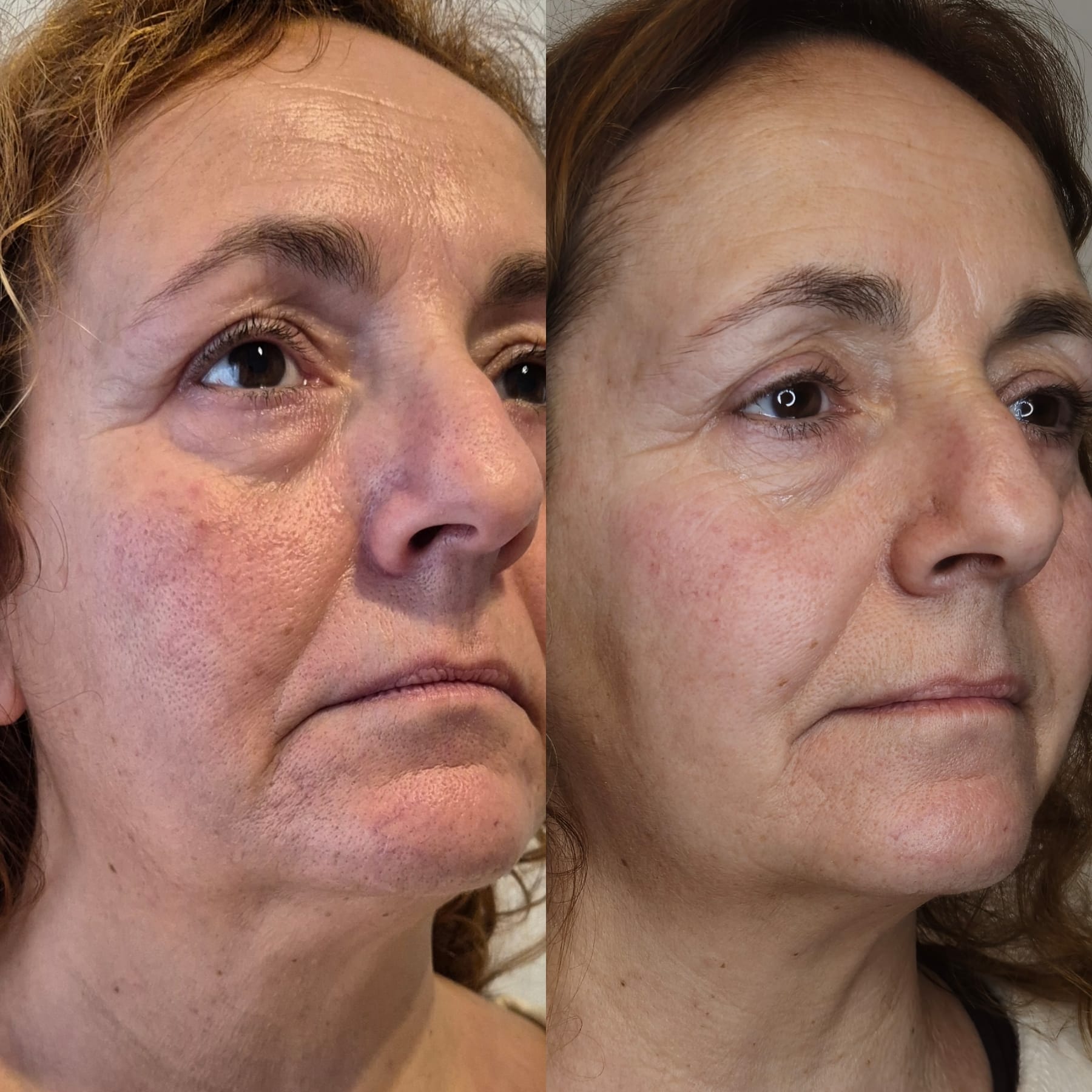Resultado HIFU facial