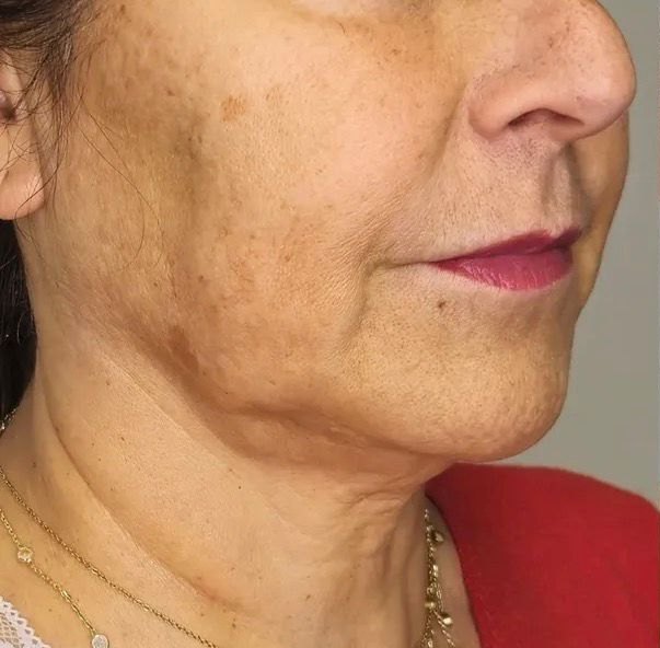 Depois — Contorno facial