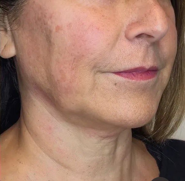 Antes — Contorno facial