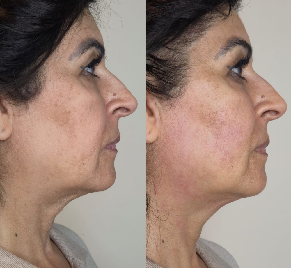 Antes e depois — Contorno facial