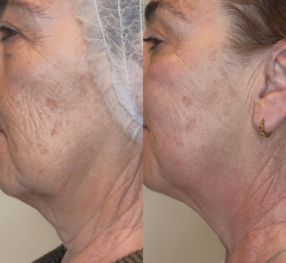 Antes e depois — Pescoço e papada